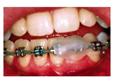 Article_image_orthosmile_wax_on_brackets